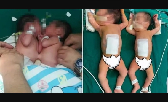 medicos chinos logran separar exitosamente a gemelas que nacieron unidas por el estomago 1