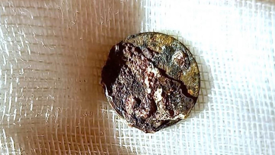 video le extraen a un hombre una moneda que se introdujo en la nariz hace 53 anos 1