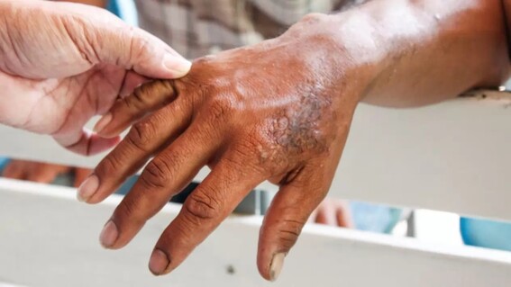 ¿cuales son los sintomas de la lepra y como se contagia